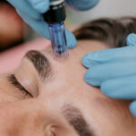 Microneedling treatment in Temecula at Forever Young Medical Spa improving skin texture and collagen production