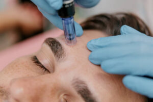 Microneedling treatment in Temecula at Forever Young Medical Spa improving skin texture and collagen production