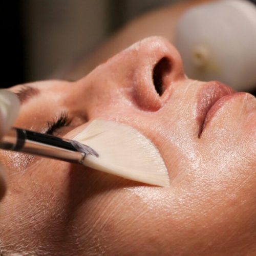 Medical-grade chemical peel treatment at Forever Young Medical Spa in Temecula improving skin tone and texture