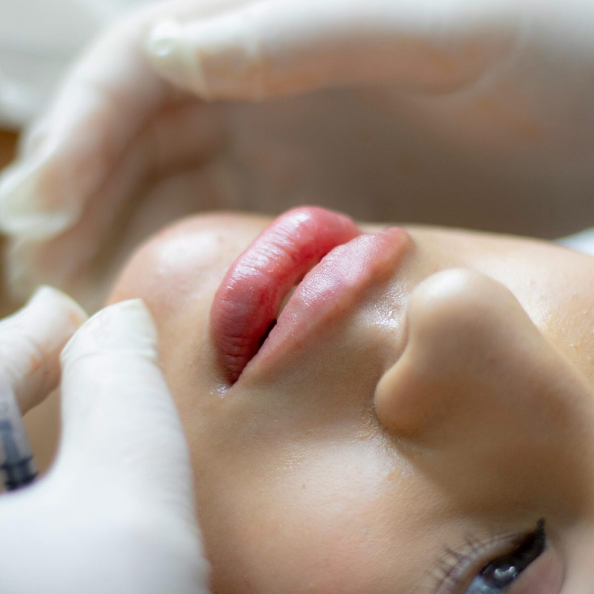 Client receiving Lip Flip Botox treatment at a Temecula medical spa for fuller natural lips